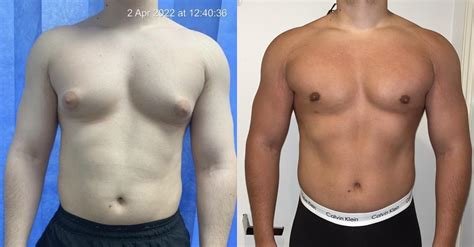 gynecomastia surgery uk.